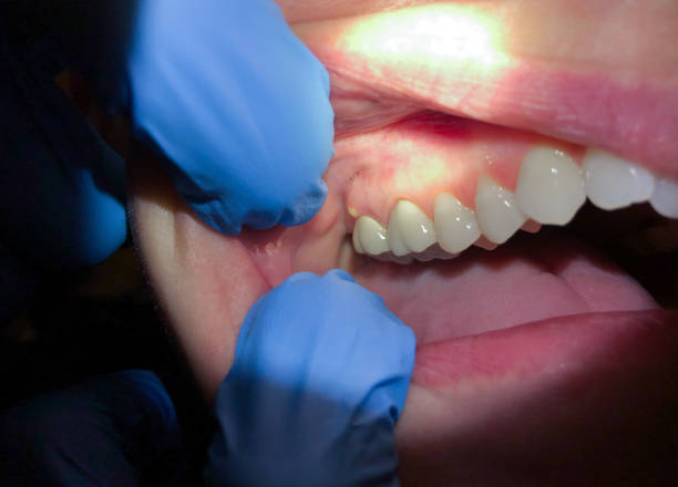 Best Dentist for Tooth Abscess  in Colby, KS